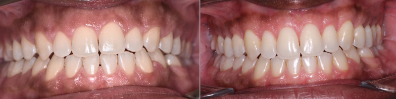 Crown Lengthening