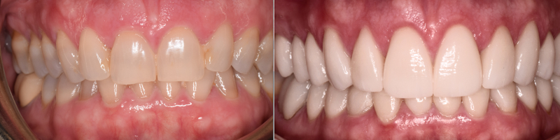 Crown Lengthening