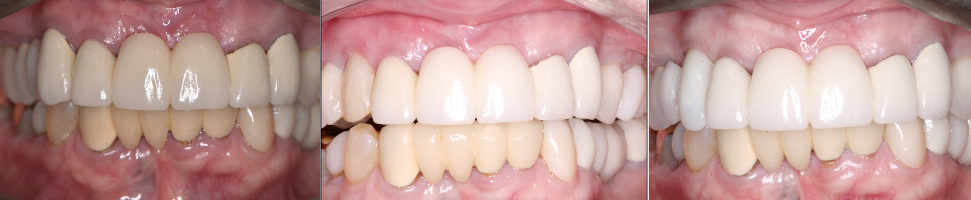 Implant