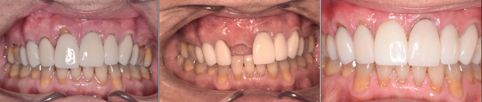 Implant Journey