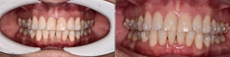 Connective Tissue Grafting