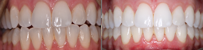 Connective Tissue Grafting Pinhole