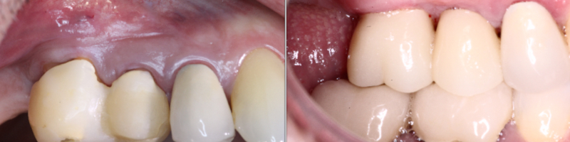 Connective Tissue Grafting Palatal