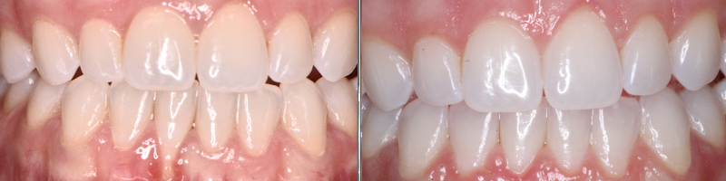 Connective Tissue Grafting Palatal