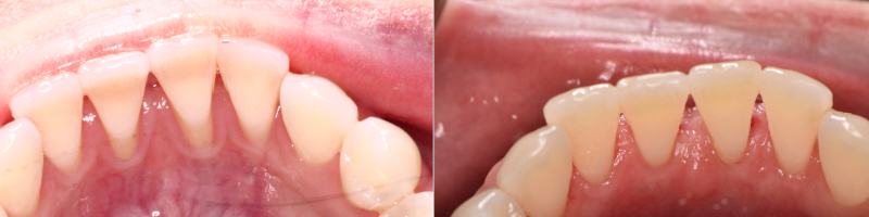 Lingual Gum Grafts