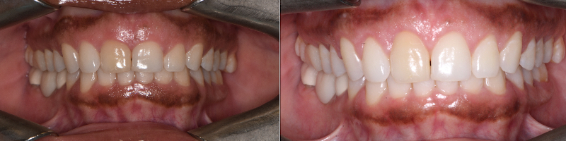 Crown Lengthening