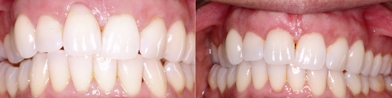 Connective Tissue Grafting