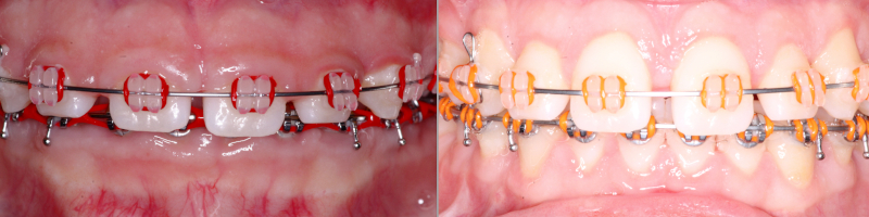 Crown Lengthening